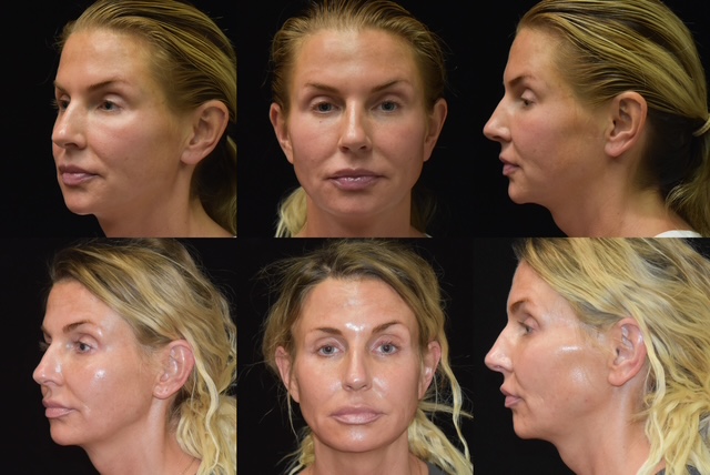 Dermal Filler patient of Dr. Burke.  Facial fillers and BOTOX were used to achieve a non-surgical facelift