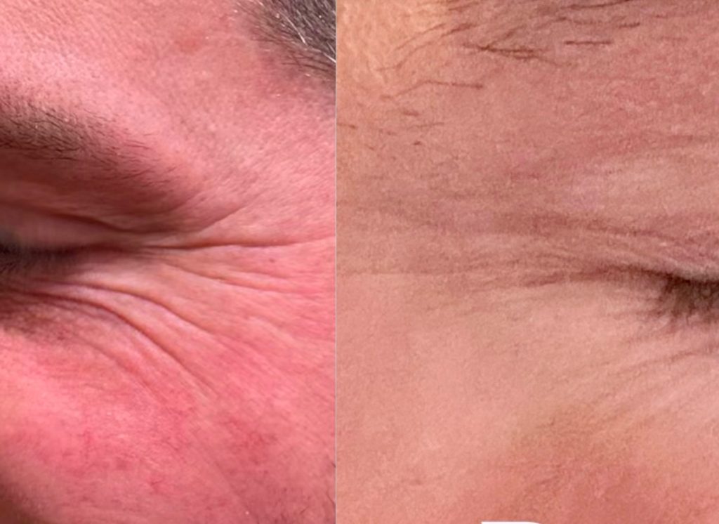 Male Botox / Neuromodulator patient of Dr. Robert Burke.  Ann Arbor BOTOX  provider.  