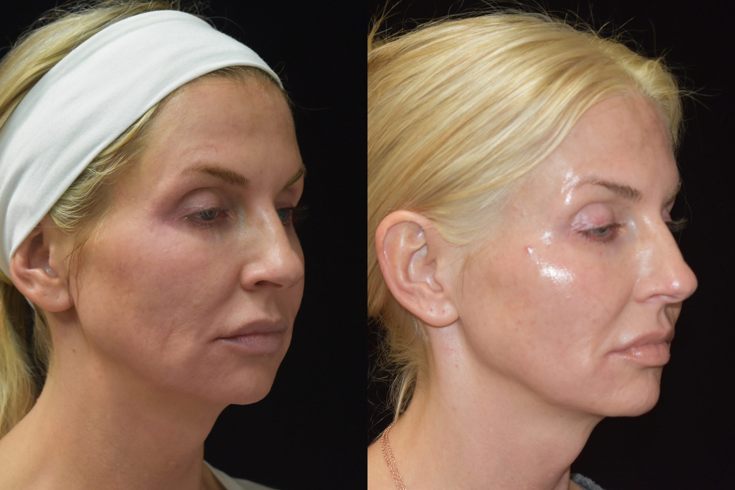 Actual Facial Filler patient of Dr. Robert Burke, Cosmetic Surgeon in Ann Arbor, Michigan