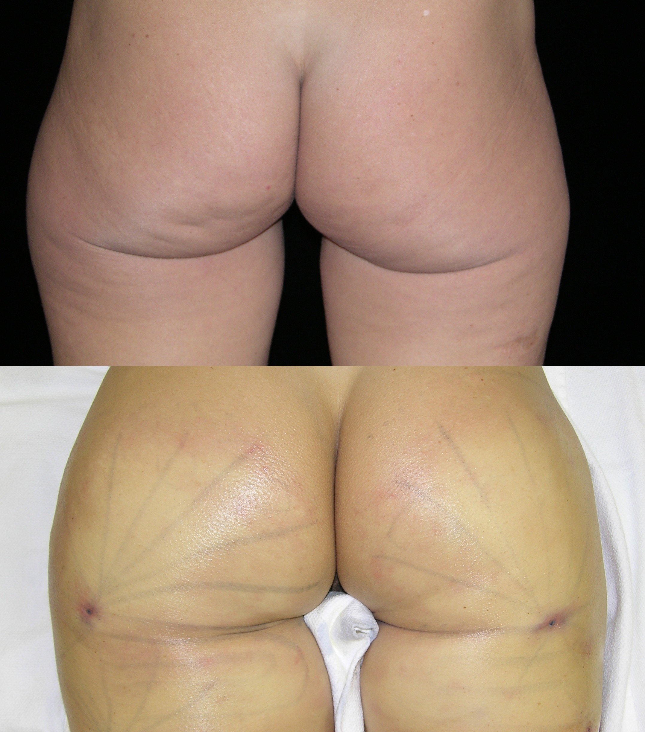 Actual non-surgical Brazilian Butt Lift patient of Dr. Robert Burke - Ann Arbor Cosmetic Surgeon