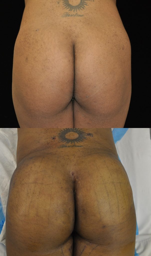 Actual non-surgical Brazilian Butt Lift patient of Dr. Robert Burke - Ann Arbor Cosmetic Surgeon