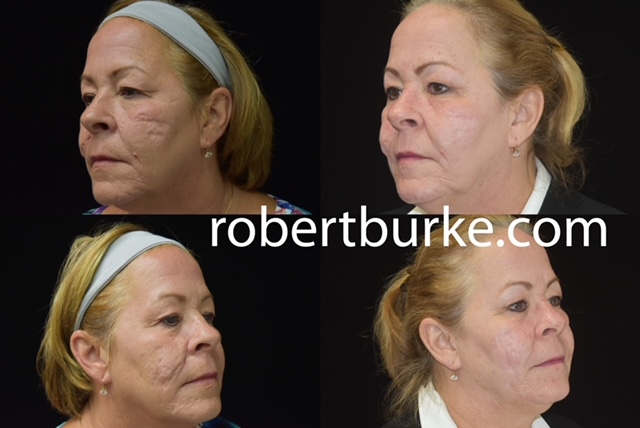 Actual Dermal Filler patient of Dr. Robert Burke, Ann Arbor Cosmetic Surgeon