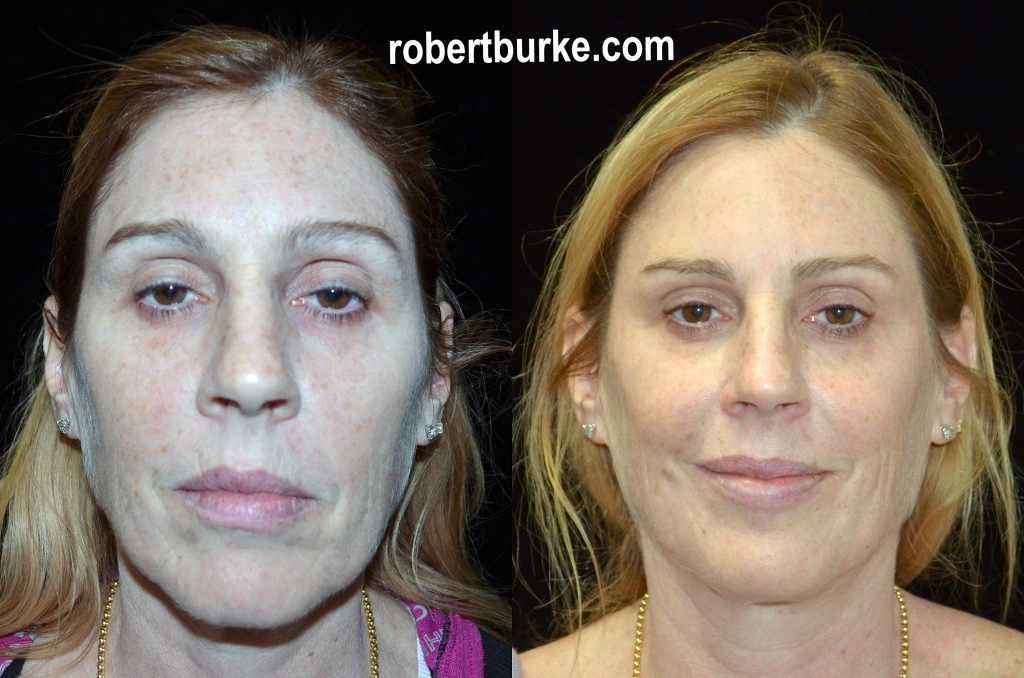 Actual Dermal Filler patient of Dr. Robert Burke, Ann Arbor Cosmetic Surgeon.