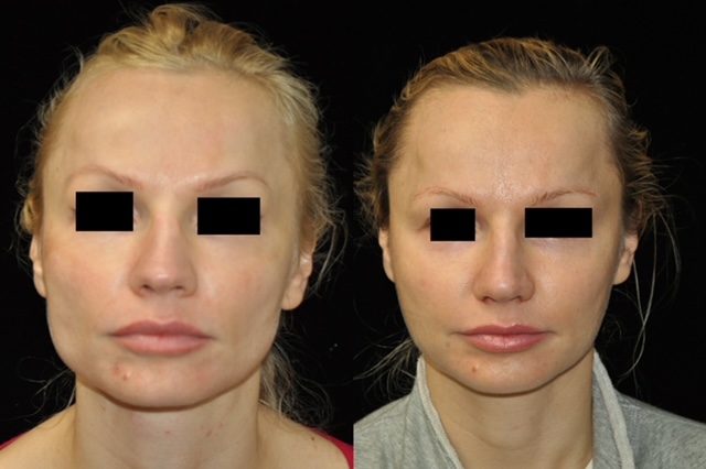 Actual jaw narrowing patient of Dr. Robert H. Burke, Cosmetic Surgeon in Ann Arbor