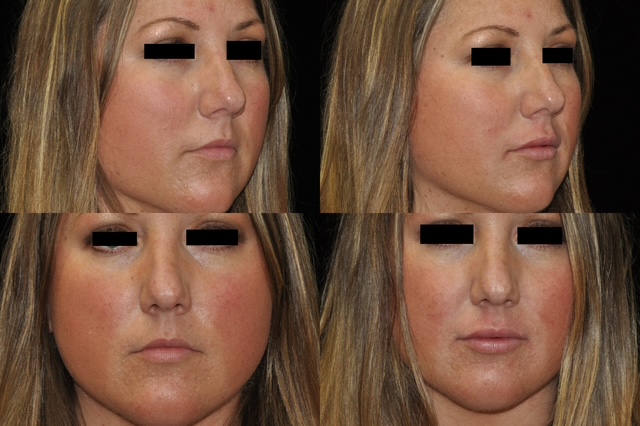 Actual facial narrowing patient of Dr. Burke, Ann Arbor Cosmetic Surgeon