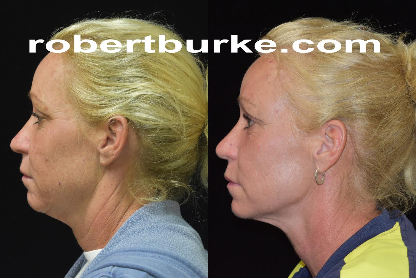 Actual Silhouette InstaLift patient of Dr. Robert Burke, Ann Arbor Cosmetic Surgeon.  Non-surgical facelift